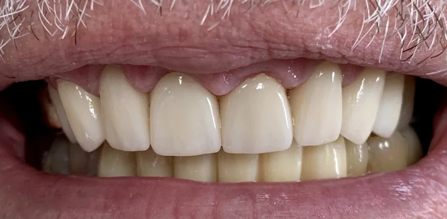 After: the upper front teeth restored with crowns.