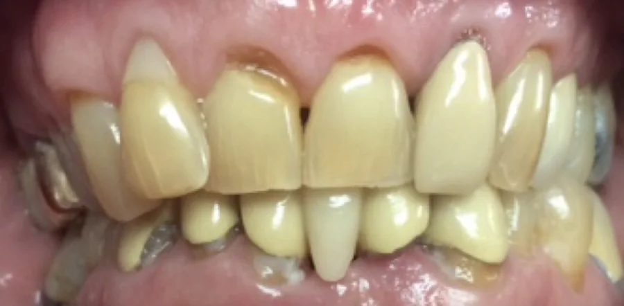 Before: worn, discolored upper front teeth.