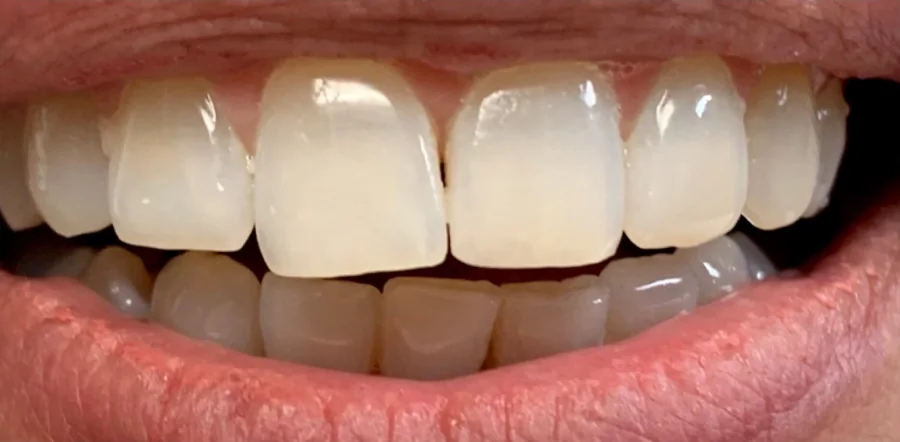 After: the upper front teeth aligned, the gap closed.