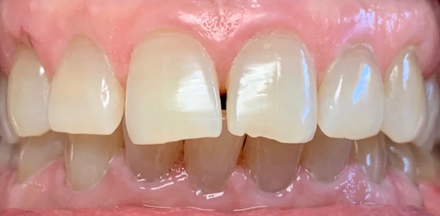 Before: a small gap and uneven edges on the upper front teeth.