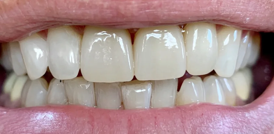 After: the upper front teeth restored, even and bright.