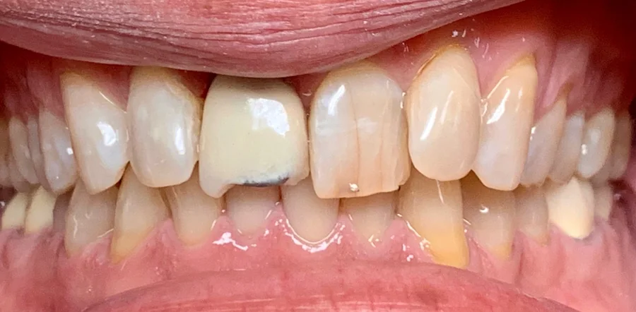 Before: discolored, chipped upper front teeth.
