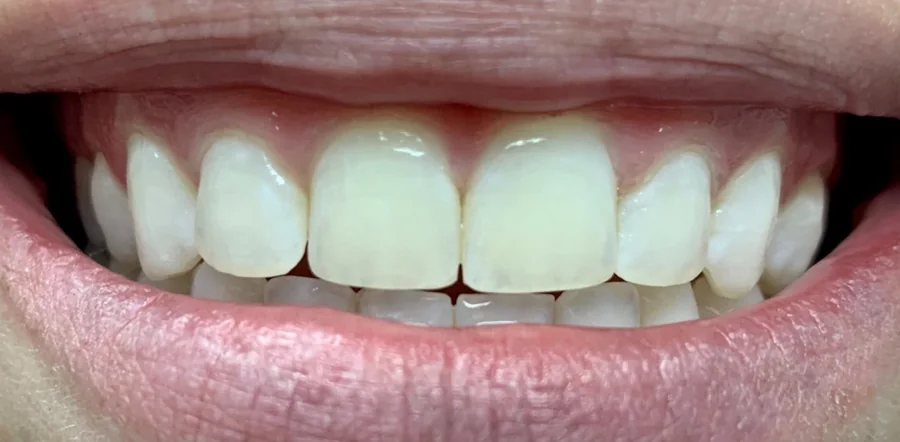 After: the two front teeth together, the gap closed.
