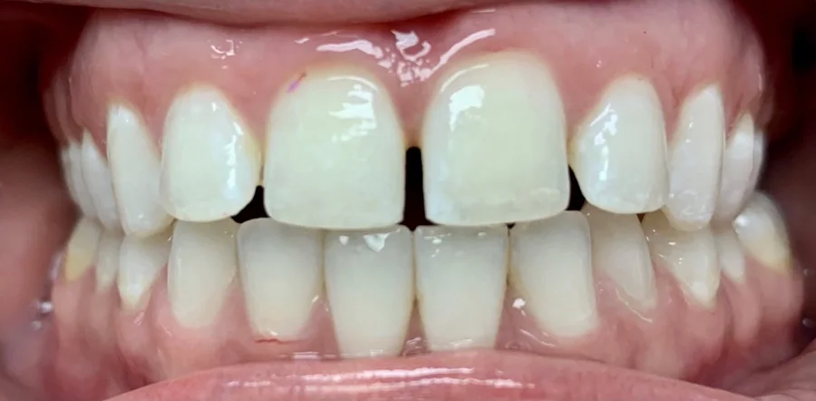 Before: a clear gap between the two upper front teeth.
