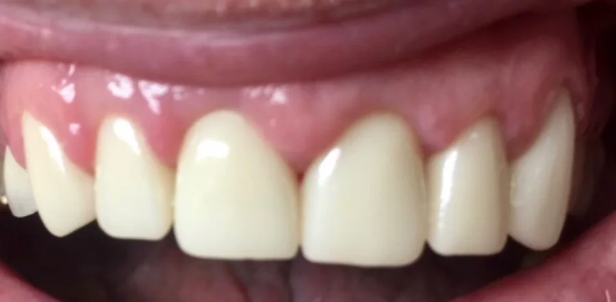 After: the upper front teeth rebuilt with crowns.