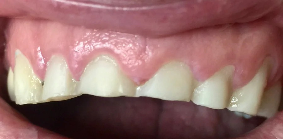 Before: chipped, worn upper front teeth.